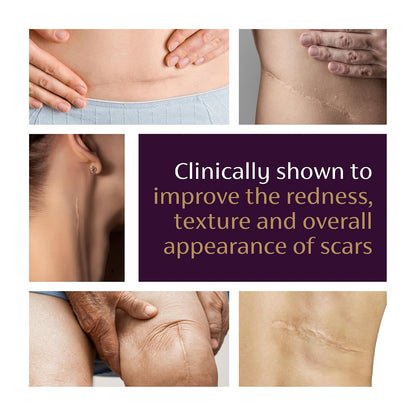 MISSPONE® Advanced Scar Gel – Smooth, Soften & Reduce the Look of New & Old Scars